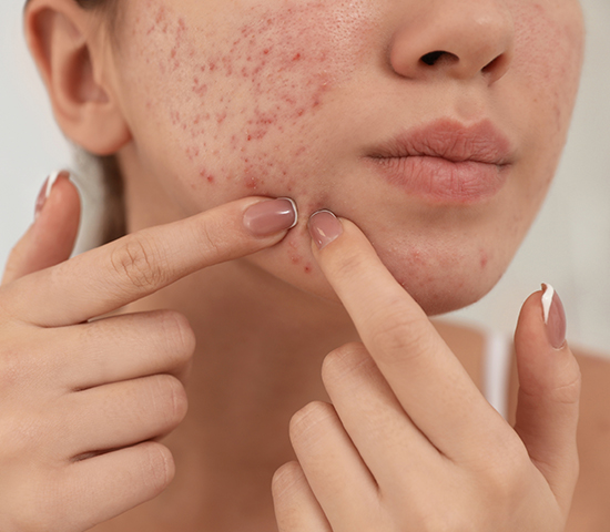 Best Ayurvedic Cream for Acne and Pimples in India